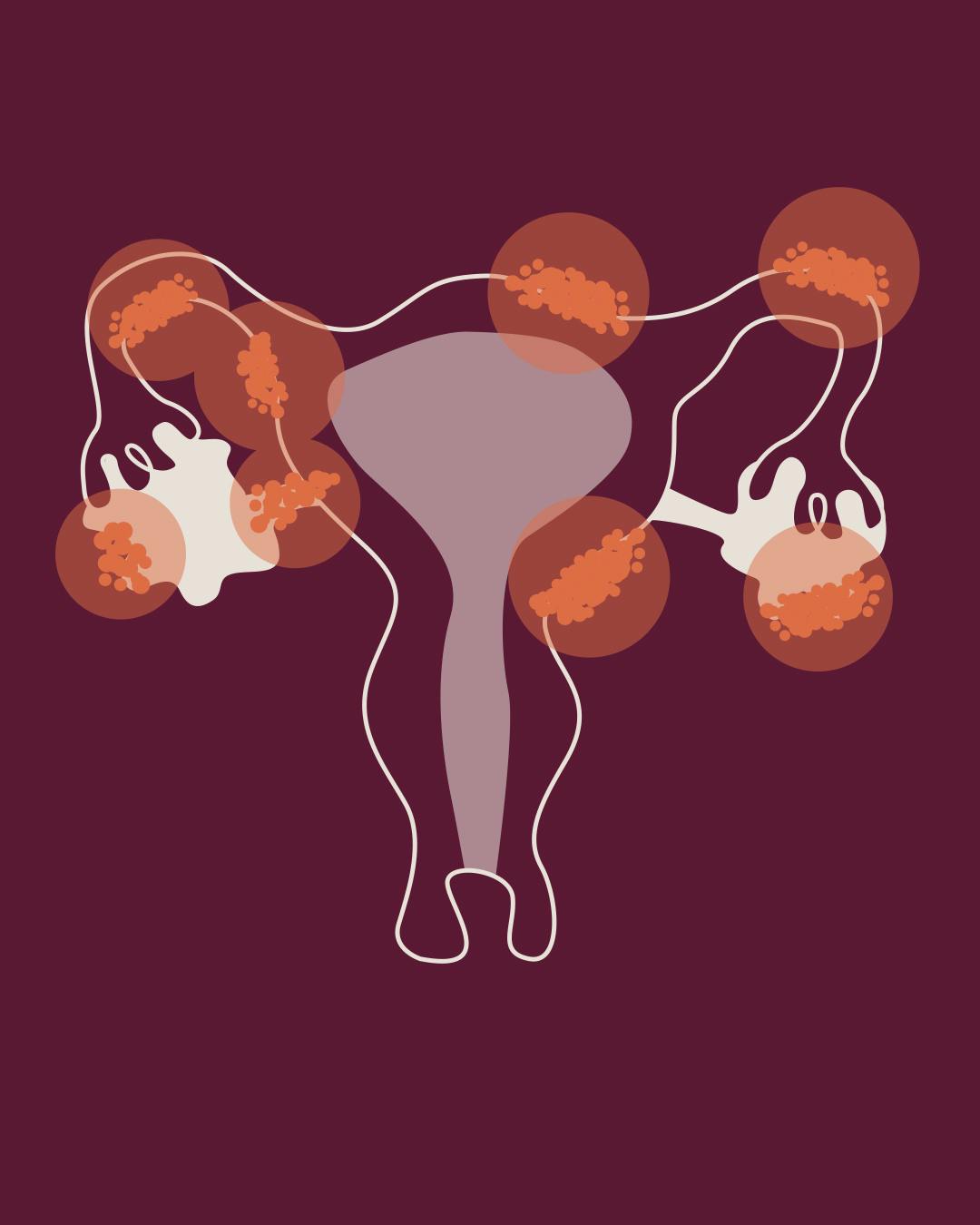 Diagram över endometrios